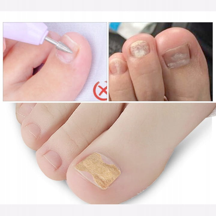 PASKI na wrastające paznokcie klamra plastry