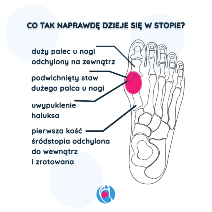 haluks-anatomia-stopy-deformacja-buty-barefoot-Bosa-Stopka.png