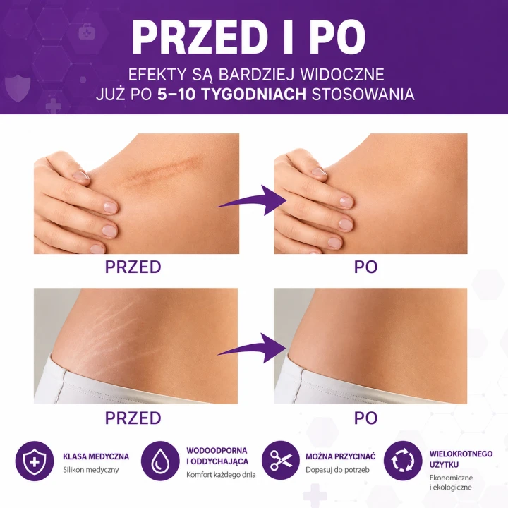 Silikonowa taśma na blizny medyczna wielokrotnego użytku – plaster silikonowy na blizny pooperacyjne i pourazowe